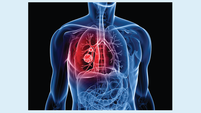 Emerging role of immunotherapy of lung cancer