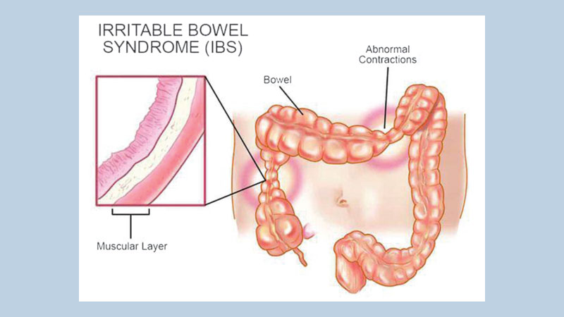 Irritable Bowel Syndrome Stool