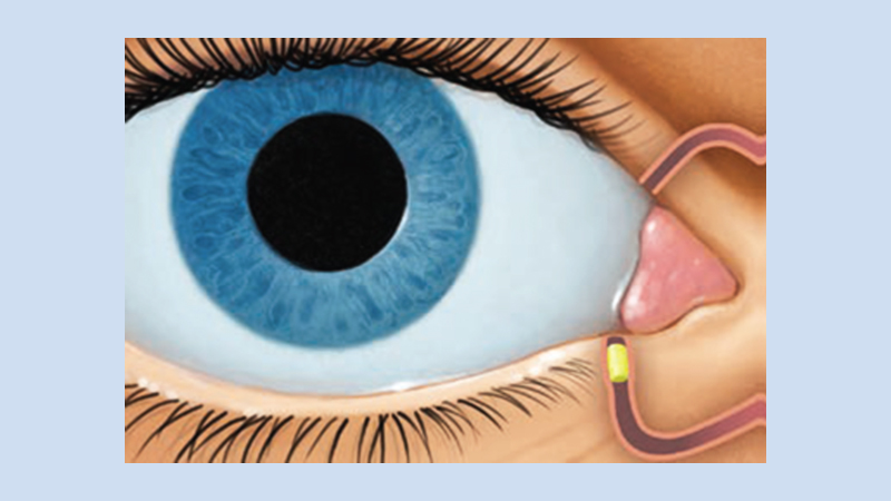 FDA approves Dextenza (dexamethasone ophthalmic insert) for the treatment of ocular pain following ophthalmic surgery