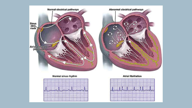 Atrial Fibrillation Abnormal Heart Rhythms And Stroke Theindependentbd