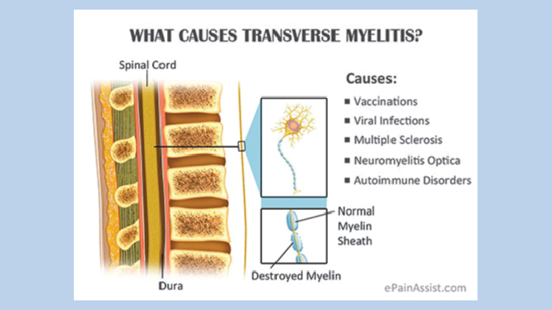 Transverse myelitis and occupational therapy | theindependentbd.com