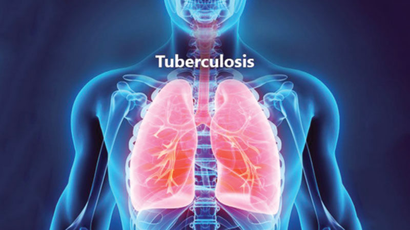 Tuberculosis (TB): Symptoms, causes & treatment